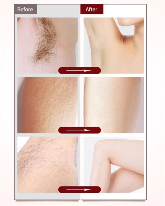 Before and after hair removal results on armpit, leg and bikini areas